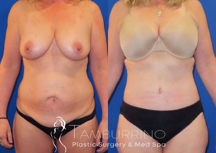 Before & After Tummy Tuck Case 29 Abdominoplasty Frontal View in Doylestown, PA