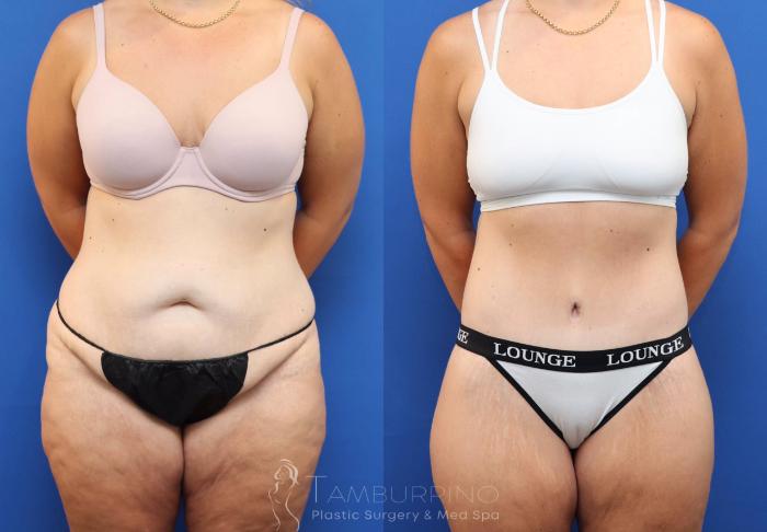 Before & After Tummy Tuck Case 83 Front View in Doylestown, PA