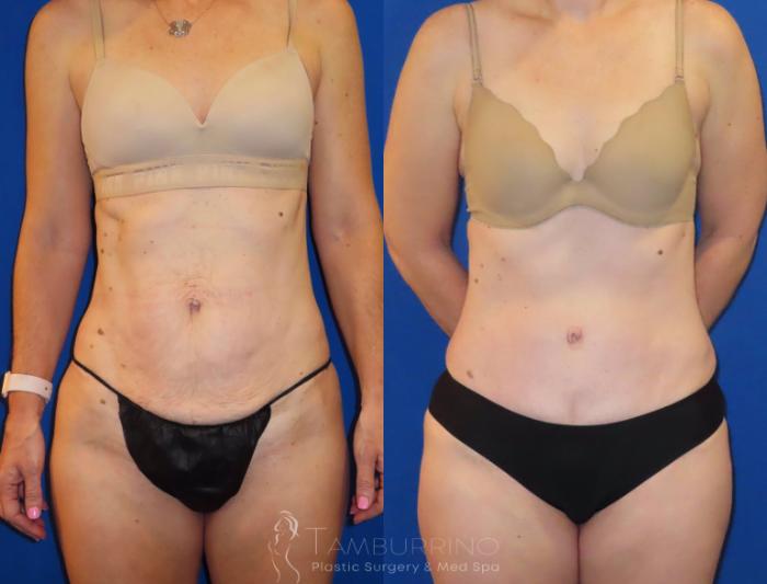 Before & After Tummy Tuck Case 34 Tummy Tuck Front View in Doylestown, PA