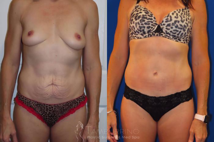 Before & After Tummy Tuck Case 35 Tummy Tuck Front View in Doylestown, PA