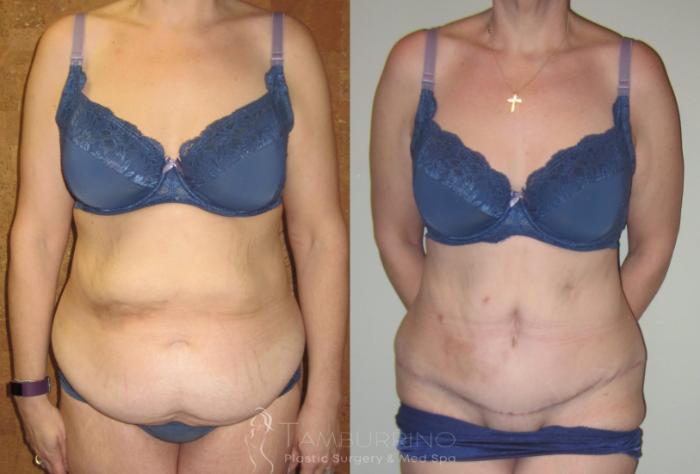Before & After Tummy Tuck Case 7 Frontal View in Doylestown, PA