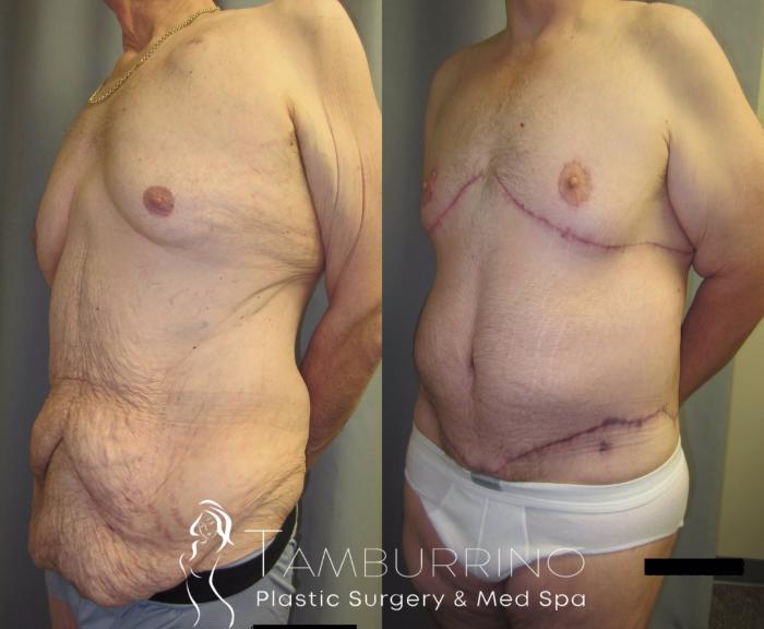 Before & After After Weight Loss Surgery Case 36 Left Oblique View in Doylestown, PA