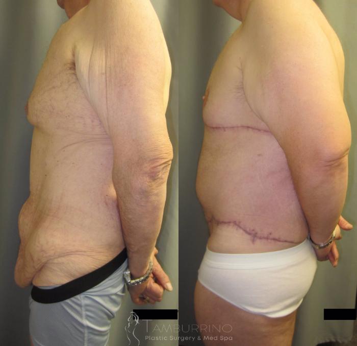 Before & After After Weight Loss Surgery Case 36 Left Side View in Doylestown, PA
