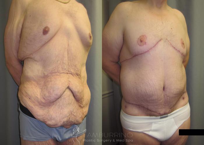 Before & After After Weight Loss Surgery Case 36 Right Oblique View in Doylestown, PA