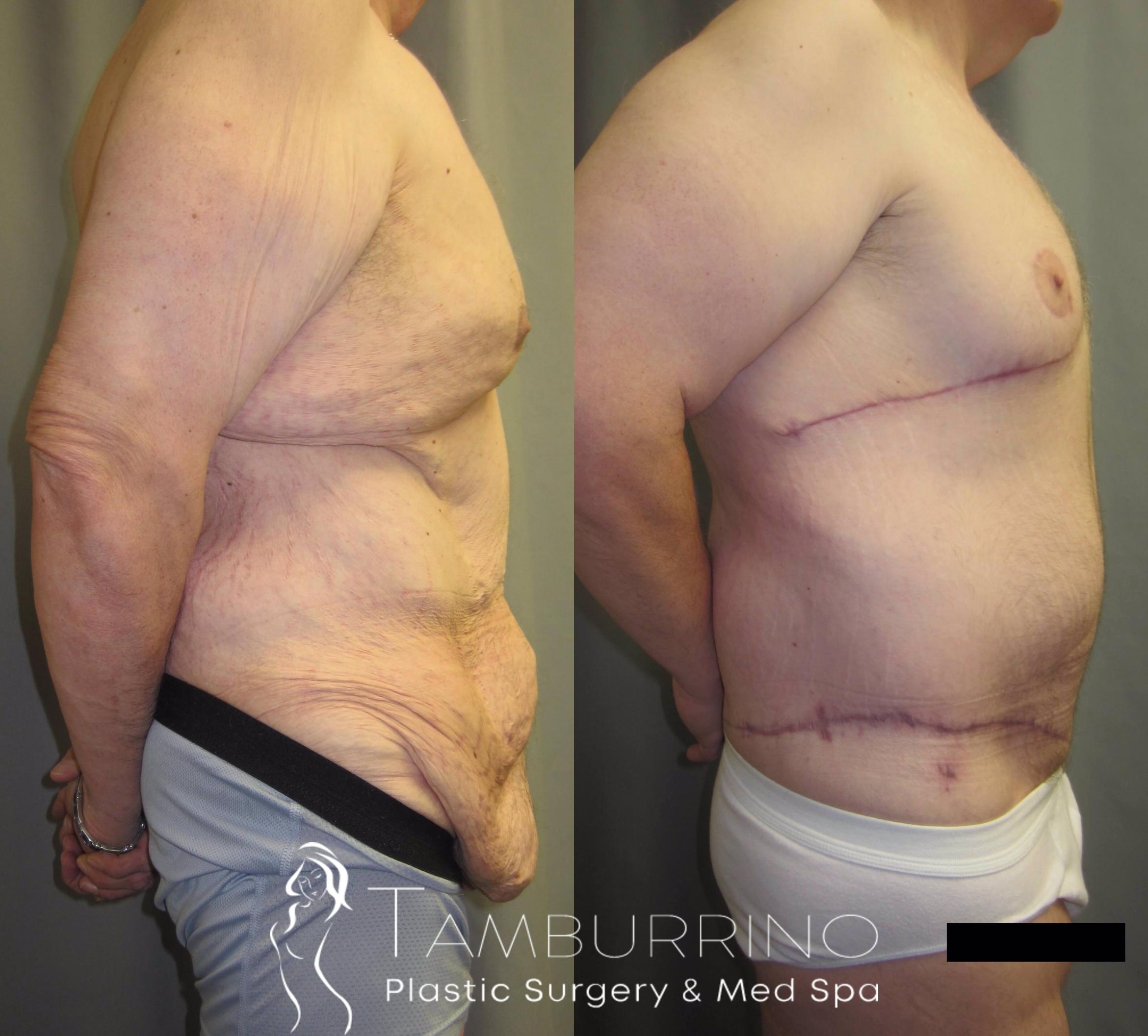 Before & After After Weight Loss Surgery Case 36 Right Side View in Doylestown, PA