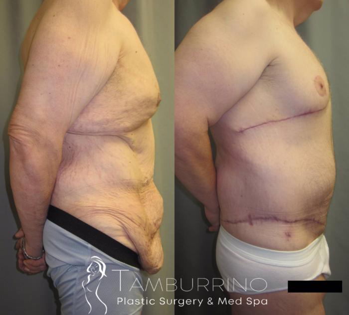 Before & After After Weight Loss Surgery Case 36 Right Side View in Doylestown, PA