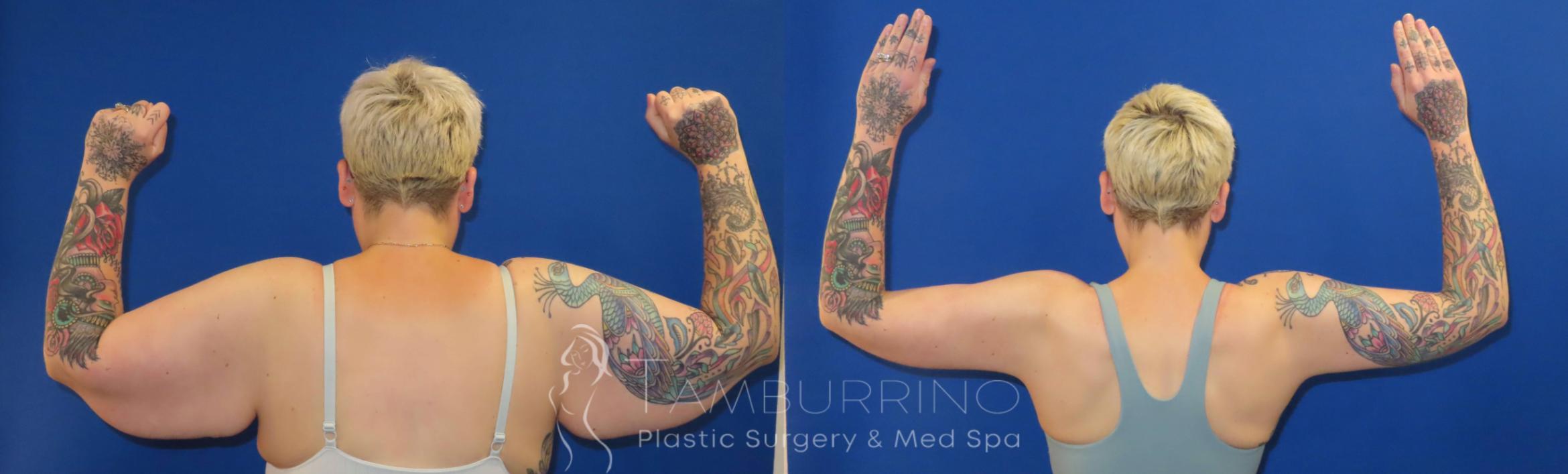 Before & After Arm Lift Case 73 Back View in Doylestown, PA