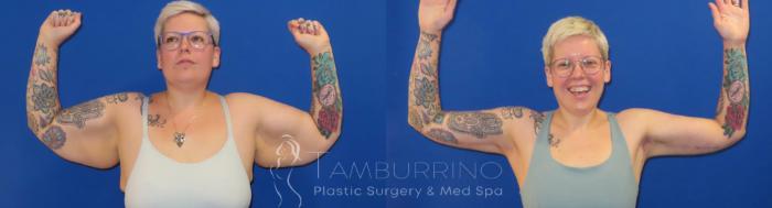 Before & After Body Contouring Case 73 Frontal View in Doylestown, PA