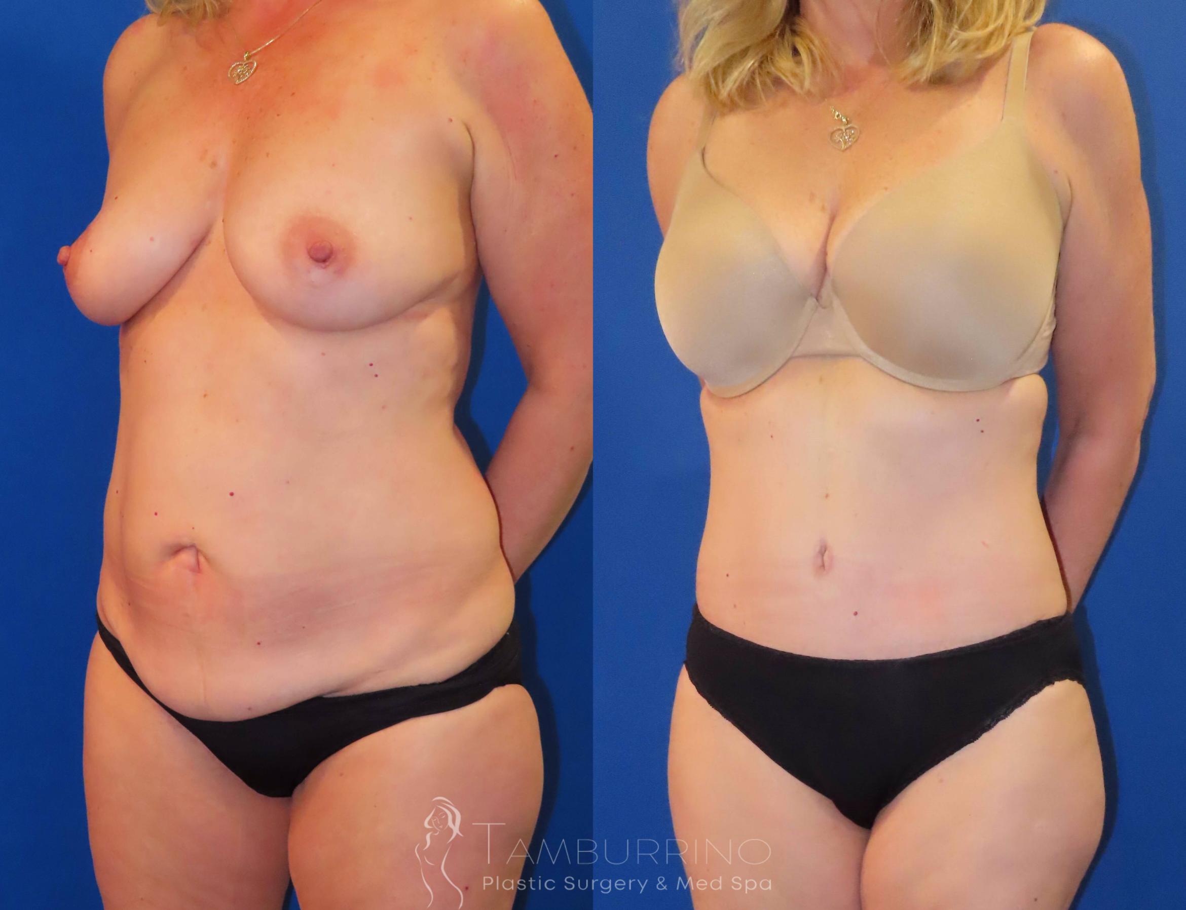 Before & After Body Contouring Case 29 Left Oblique View in Doylestown, PA