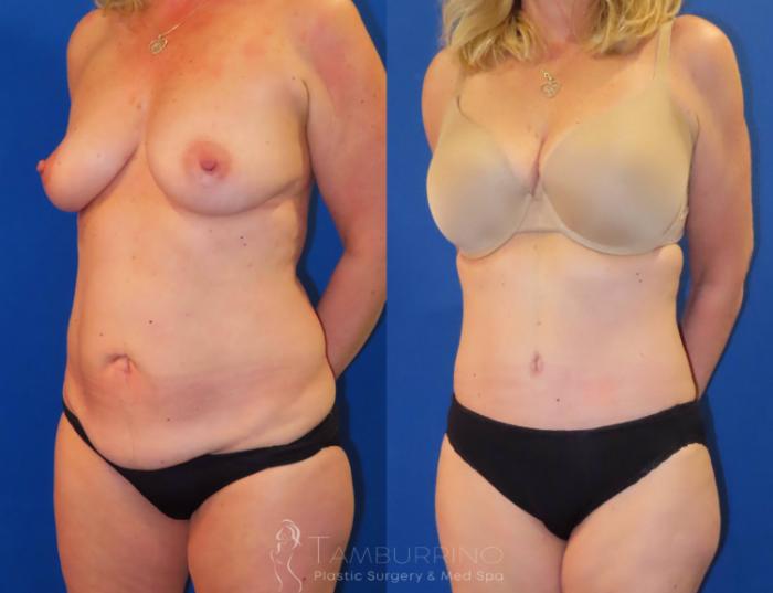 Before & After Body Contouring Case 29 Left Oblique View in Doylestown, PA