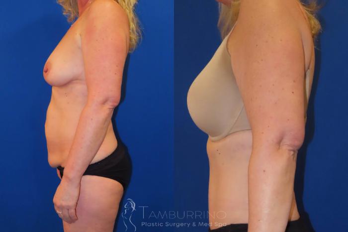 Before & After Body Contouring Case 29 Left Side View in Doylestown, PA
