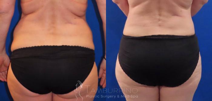 Before & After Body Contouring Case 29 Lower Back Liposuction View in Doylestown, PA