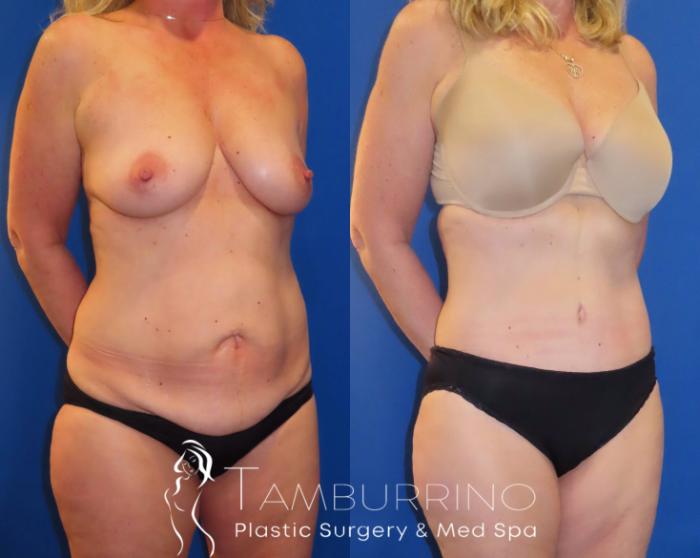 Before & After Body Contouring Case 29 Right Oblique View in Doylestown, PA
