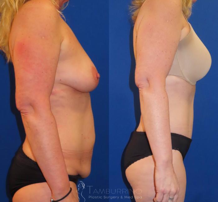 Before & After Body Contouring Case 29 Right Side View in Doylestown, PA