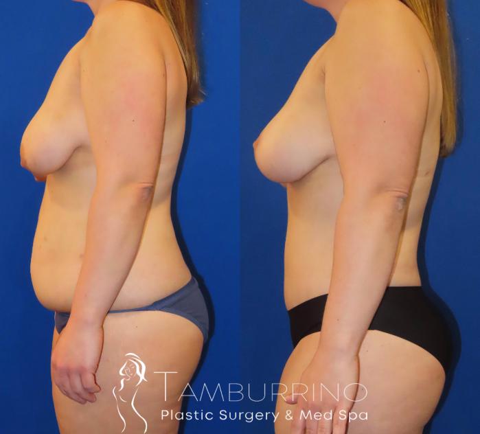 Before & After Body Contouring Case 31 Left Side View in Doylestown, PA