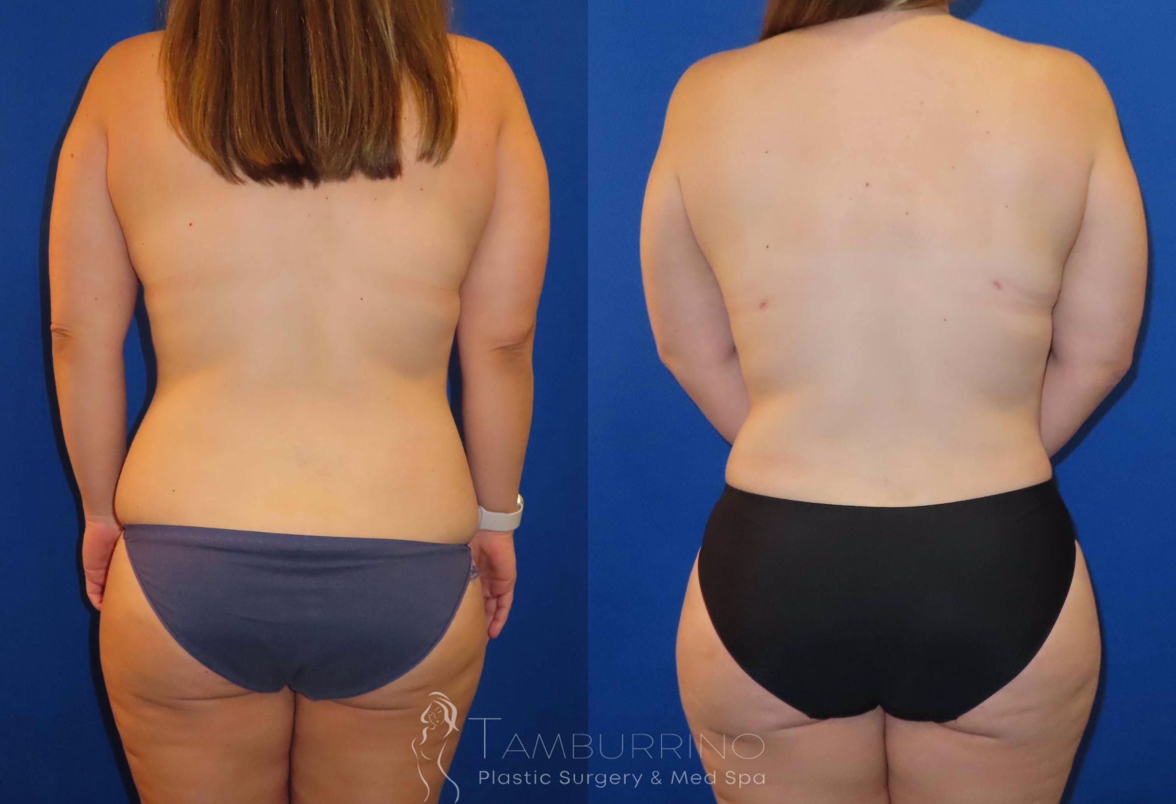 Before & After Body Contouring Case 31 Lower Back Liposuction View in Doylestown, PA