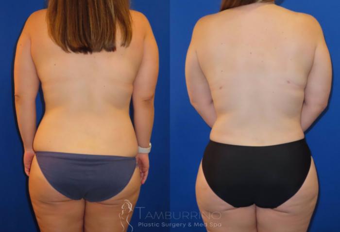 Before & After Body Contouring Case 31 Lower Back Liposuction View in Doylestown, PA