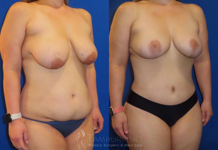 Before & After Body Contouring Case 31 Right Oblique View in Doylestown, PA