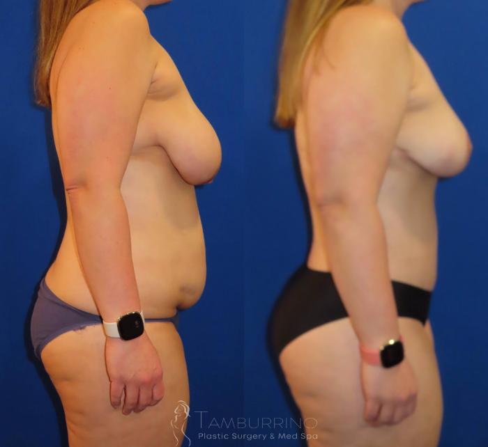 Before & After Body Contouring Case 31 Right Side View in Doylestown, PA