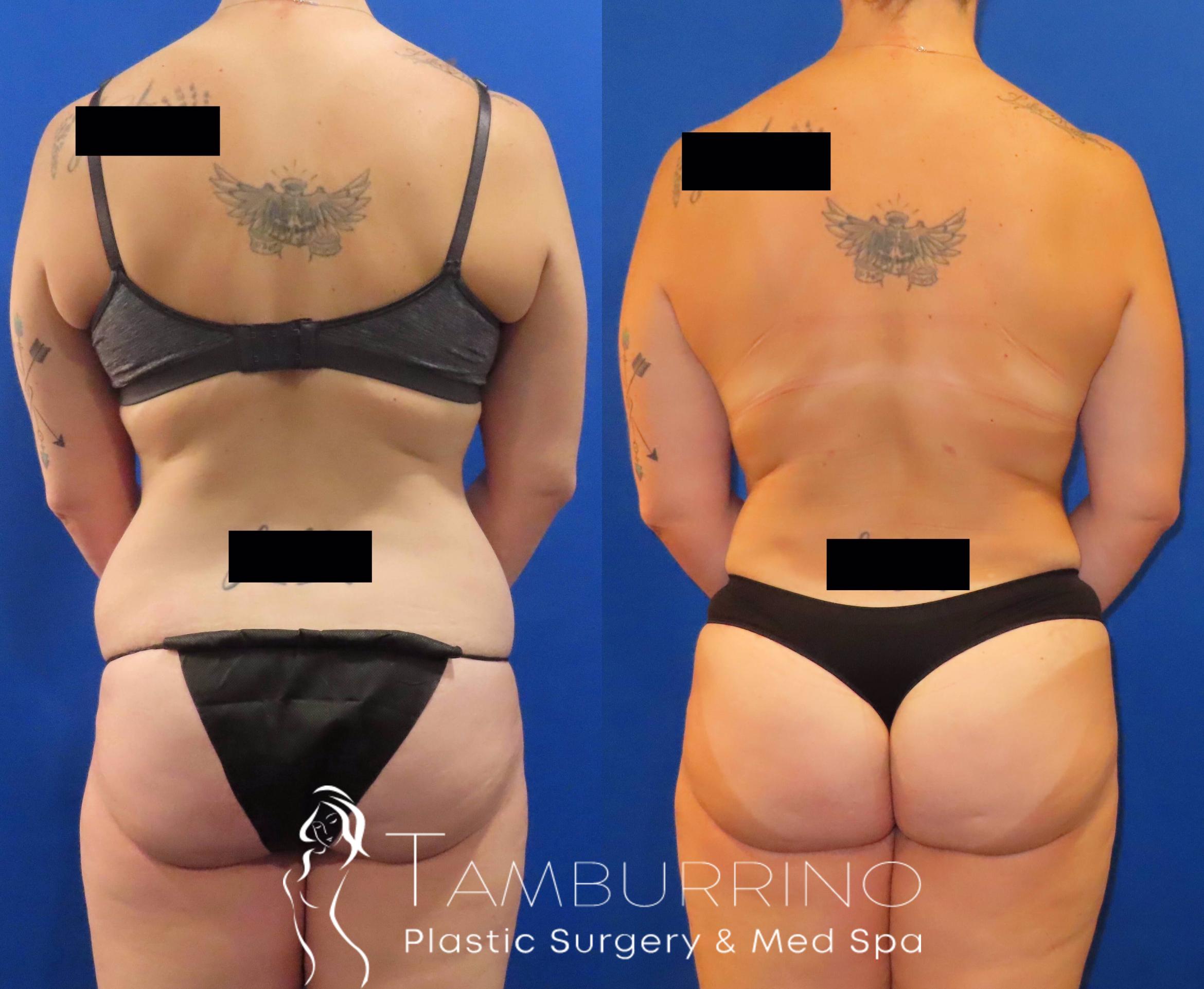 Before & After Body Contouring Case 33 Back & Flank Liposuction View in Doylestown, PA