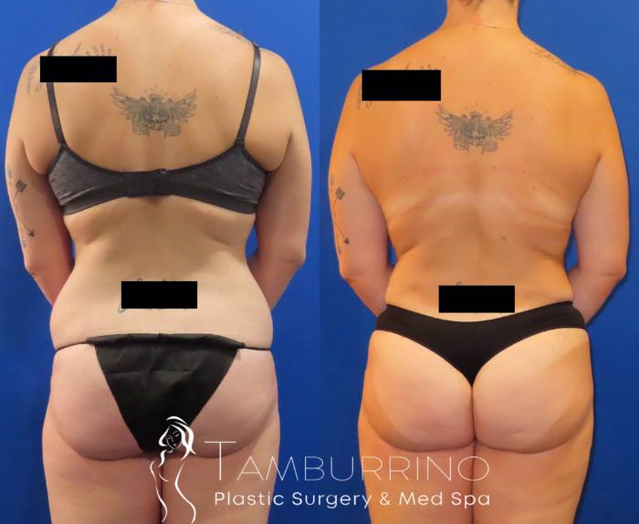 Before & After Body Contouring Case 33 Back & Flank Liposuction View in Doylestown, PA