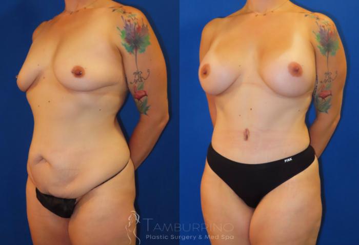 Before & After Body Contouring Case 33 Left Oblique View in Doylestown, PA