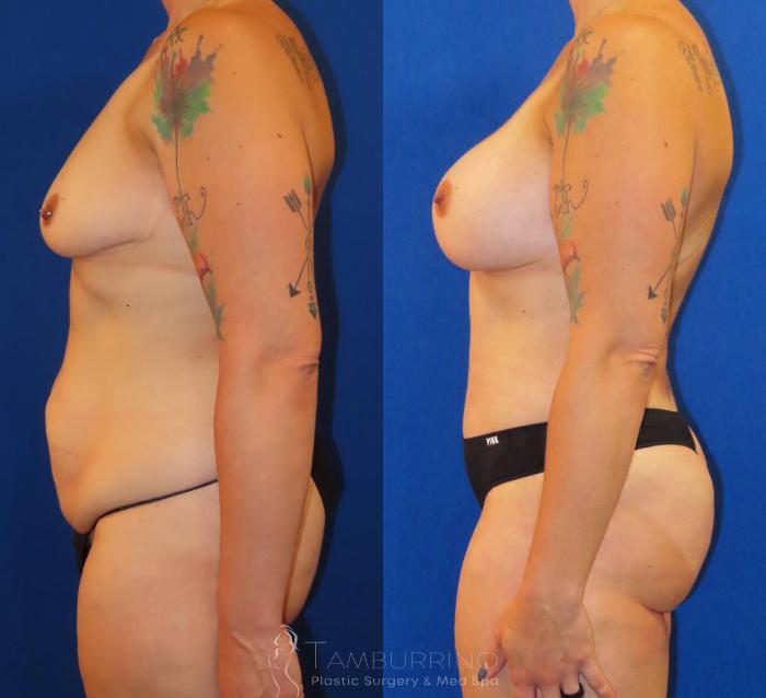 Before & After Body Contouring Case 33 Left Side View in Doylestown, PA