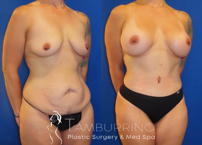 Before & After Body Contouring Case 33 Right Oblique View in Doylestown, PA