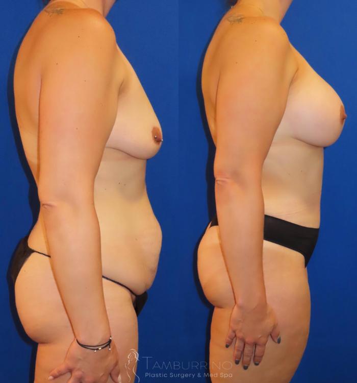 Before & After Body Contouring Case 33 Right Side View in Doylestown, PA
