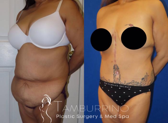 Before & After Body Contouring Case 37 Left Oblique View in Doylestown, PA