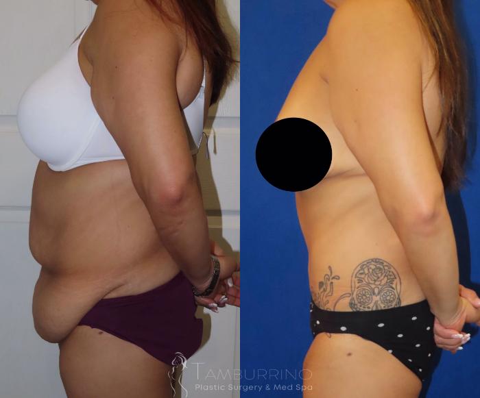 Before & After Body Contouring Case 37 Left Side View in Doylestown, PA