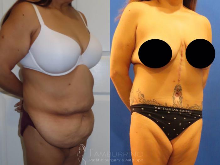 Before & After Body Contouring Case 37 Right Oblique View in Doylestown, PA