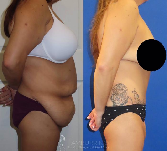 Before & After Body Contouring Case 37 Right Side View in Doylestown, PA