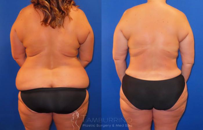 Before & After Body Contouring Case 38 Back & Low Waist Liposuction View in Doylestown, PA
