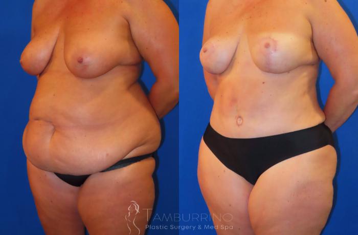 Before & After Body Contouring Case 38 Left Oblique View in Doylestown, PA