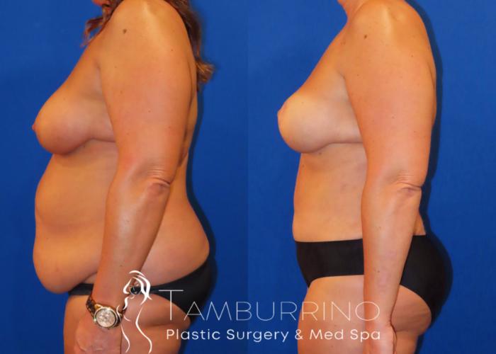 Before & After Body Contouring Case 38 Left Side View in Doylestown, PA