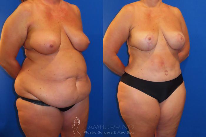 Before & After Body Contouring Case 38 Right Oblique View in Doylestown, PA