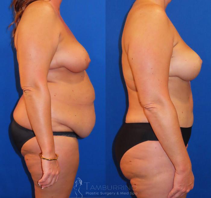 Before & After Body Contouring Case 38 Right Side View in Doylestown, PA