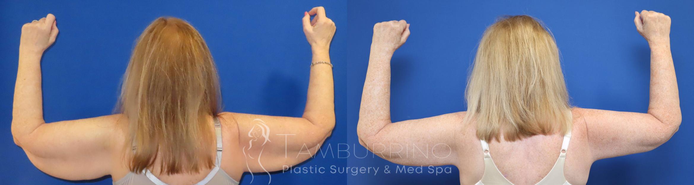 Before & After Arm Lift Case 74 Back View in Doylestown, PA
