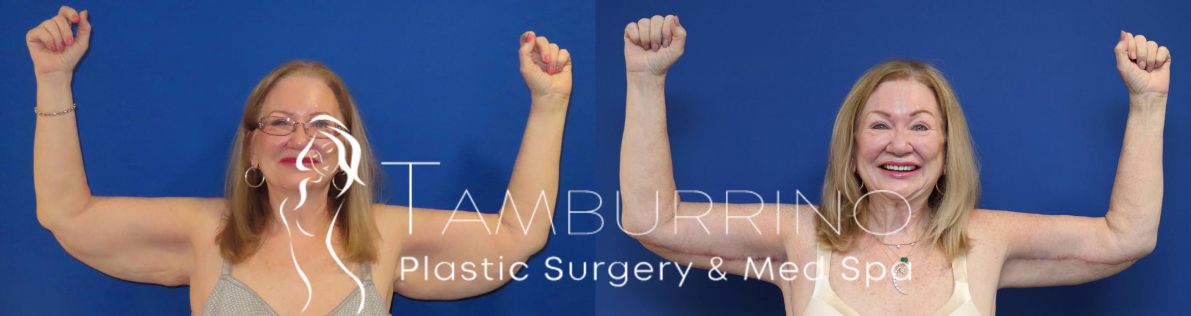 Before & After Arm Lift Case 74 Frontal View in Doylestown, PA