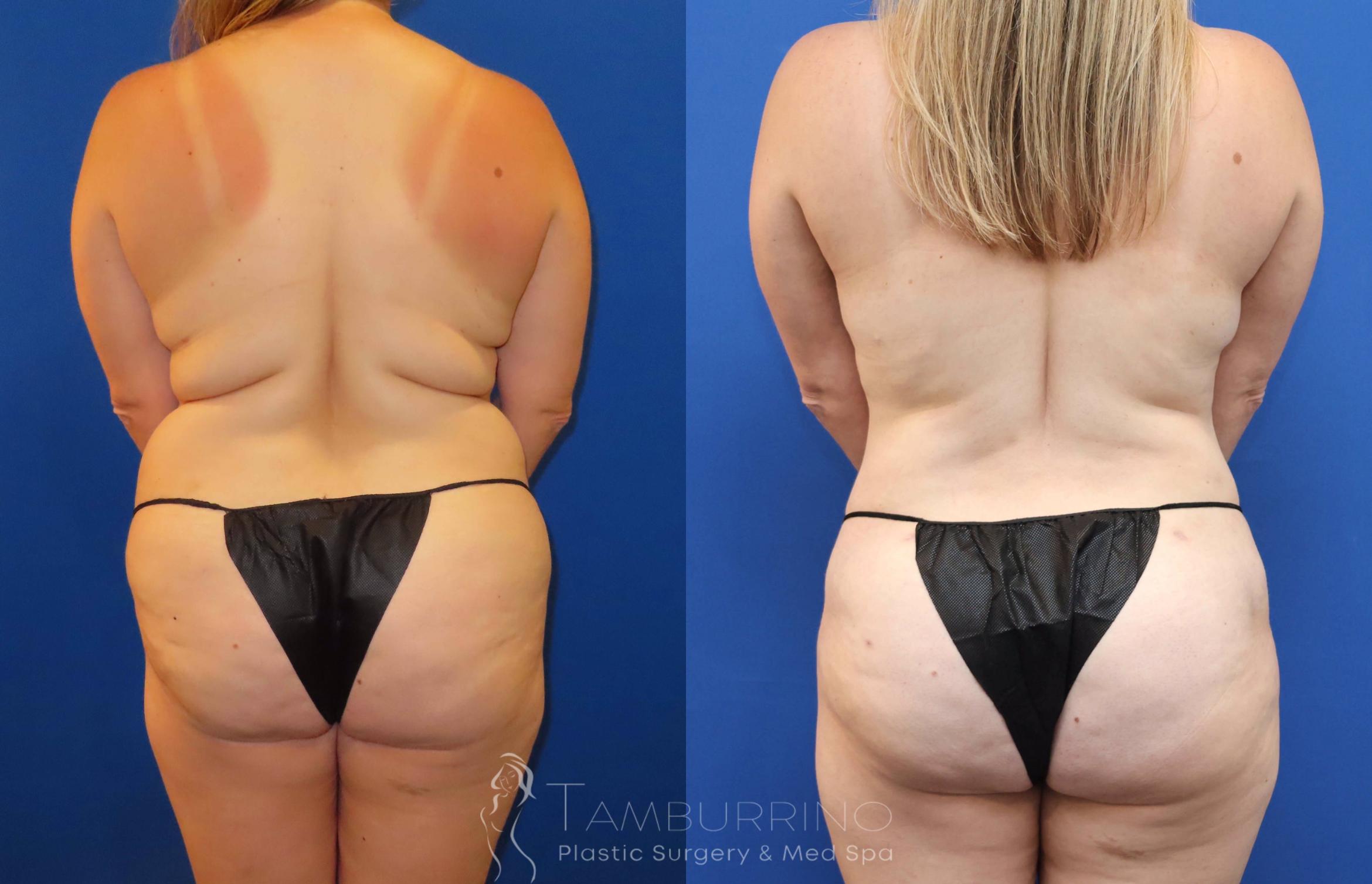 Before & After Brazilian Butt Lift Case 71 Rear View in Doylestown, PA