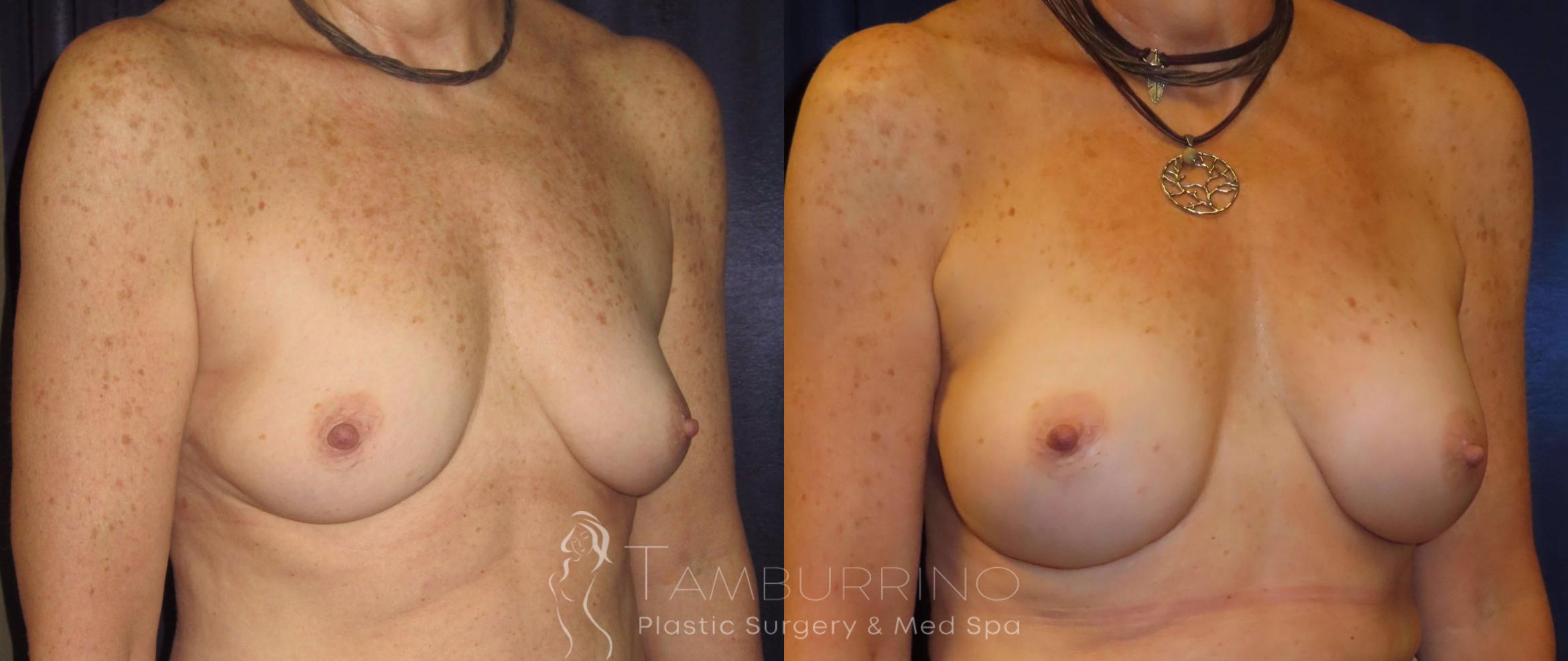 Before & After Breast Augmentation Case 11 Oblique #1 View in Doylestown, PA
