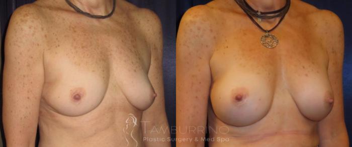 Before & After Breast Augmentation Case 11 Oblique #1 View in Doylestown, PA