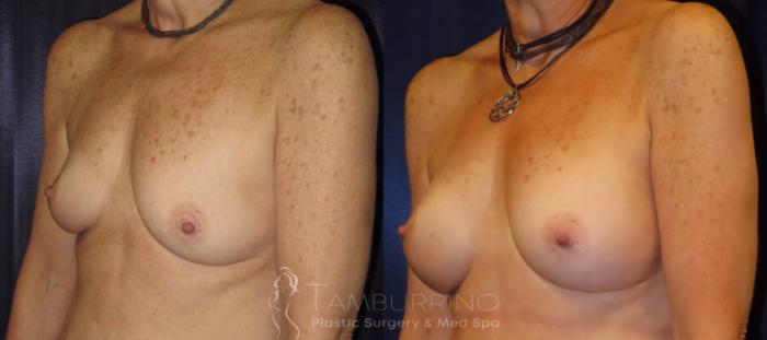 Before & After Breast Augmentation Case 11 Oblique #2 View in Doylestown, PA