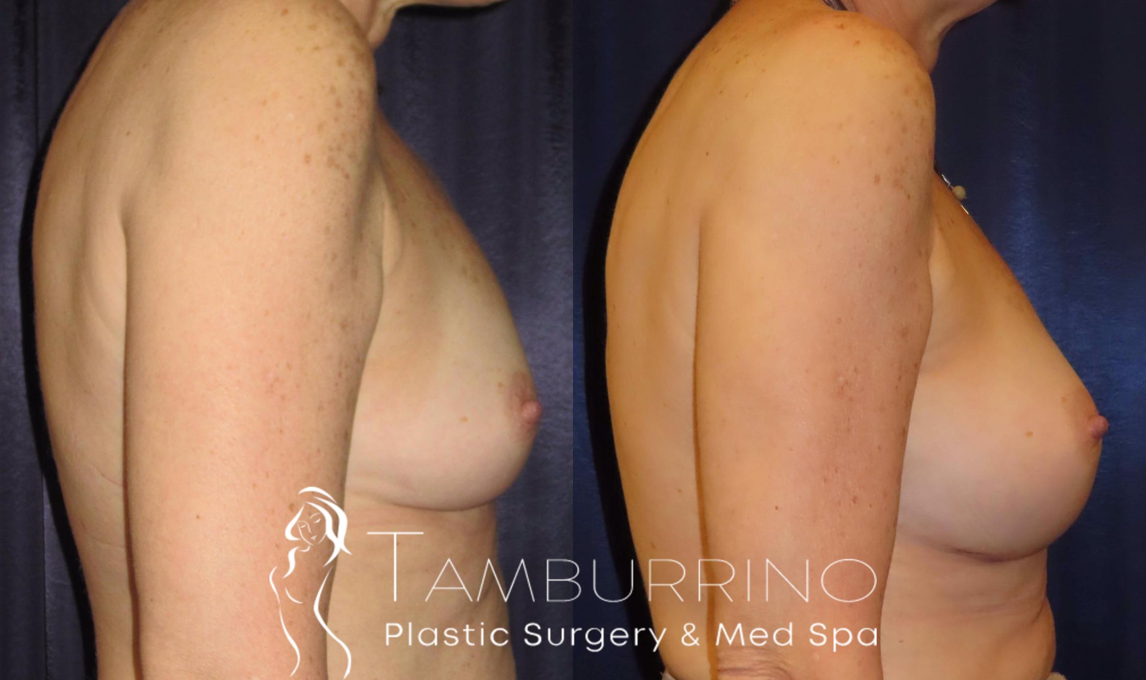 Before & After Breast Augmentation Case 11 Side View in Doylestown, PA