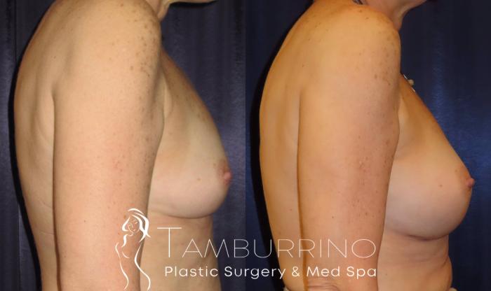 Before & After Breast Augmentation Case 11 Side View in Doylestown, PA