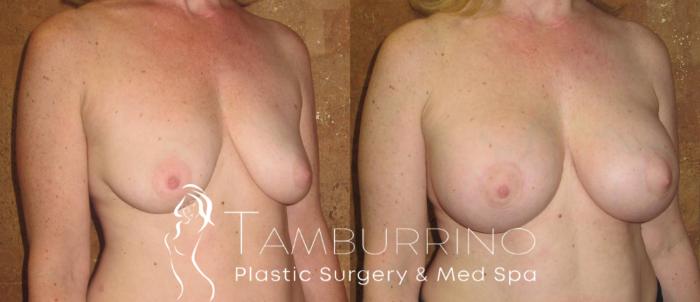 Before & After Breast Augmentation Case 14 Oblique #1 View in Doylestown, PA