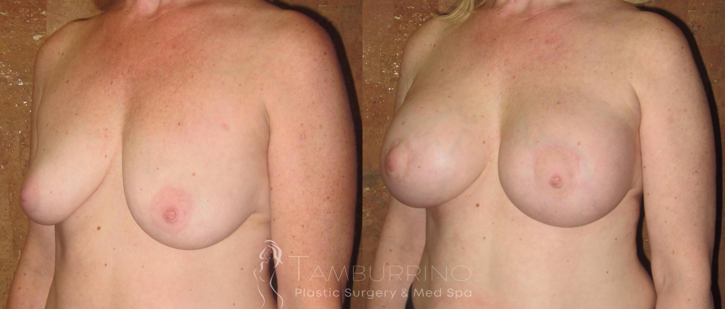 Before & After Breast Augmentation Case 14 Oblique #2 View in Doylestown, PA