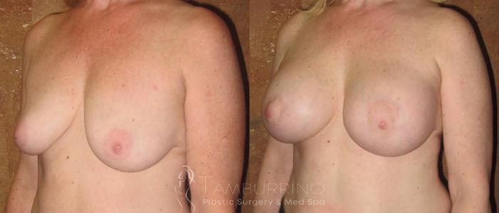 Before & After Breast Augmentation Case 14 Oblique #2 View in Doylestown, PA