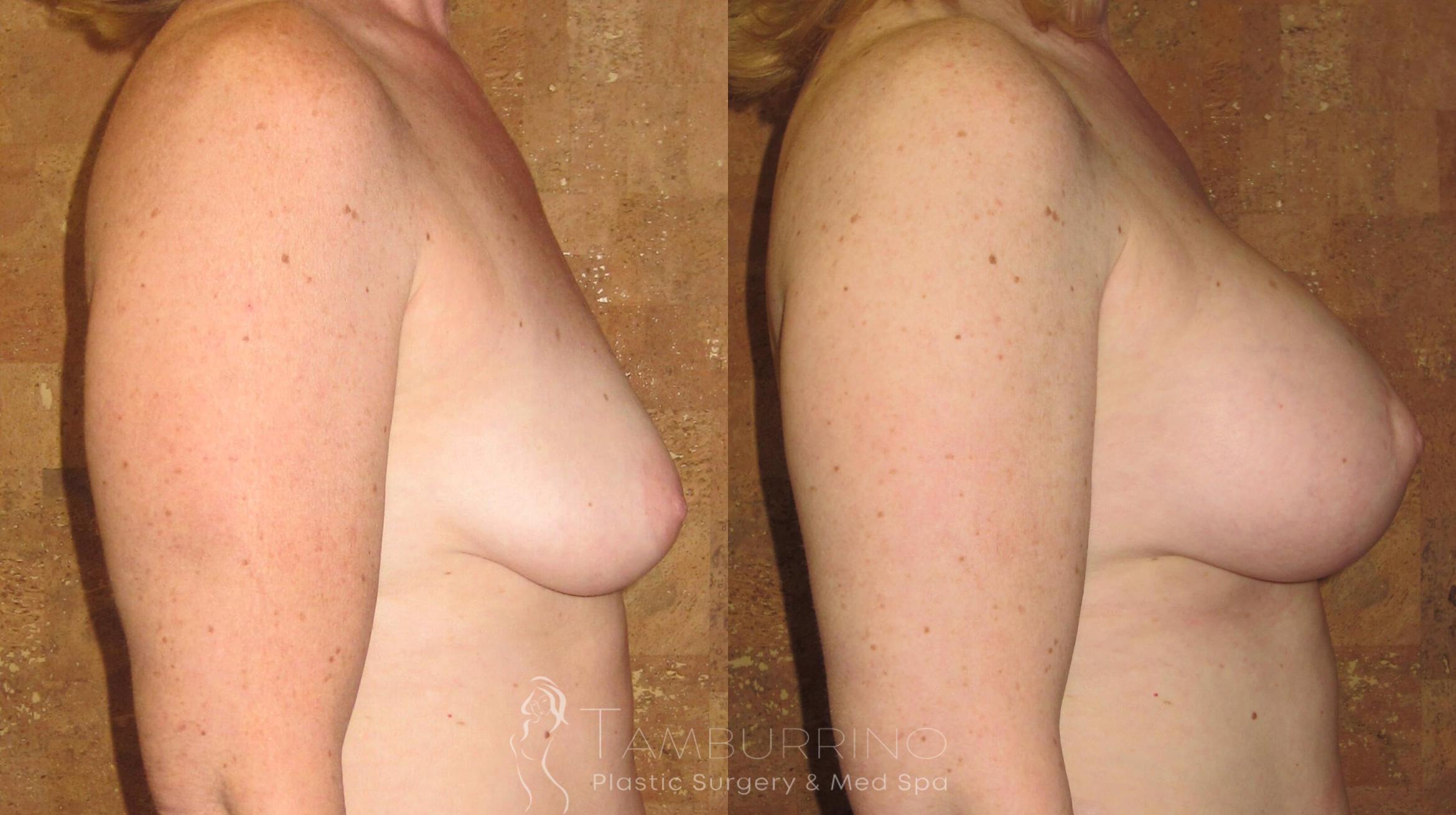 Before & After Breast Augmentation Case 14 Side #1 View in Doylestown, PA
